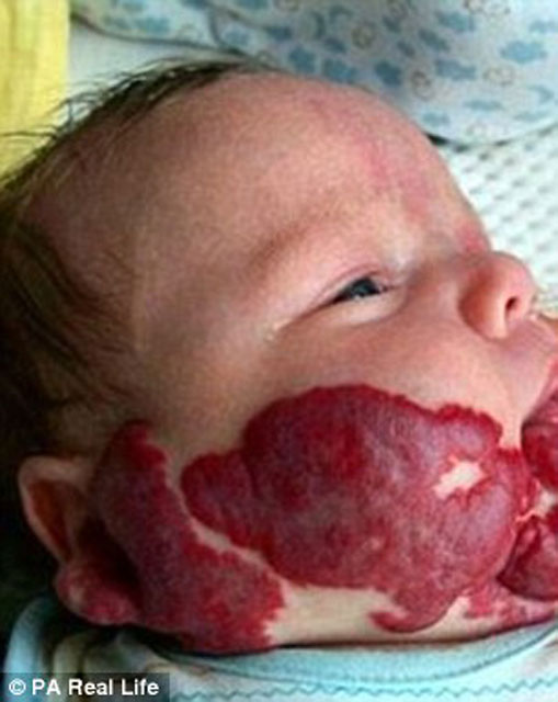 Doğum lekesi öldürüyordu! Sayfa 1 Bebek Haberleri