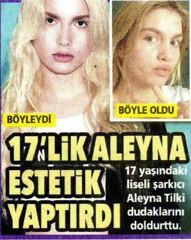 Aleyna Tilki estetik yaptırdı!