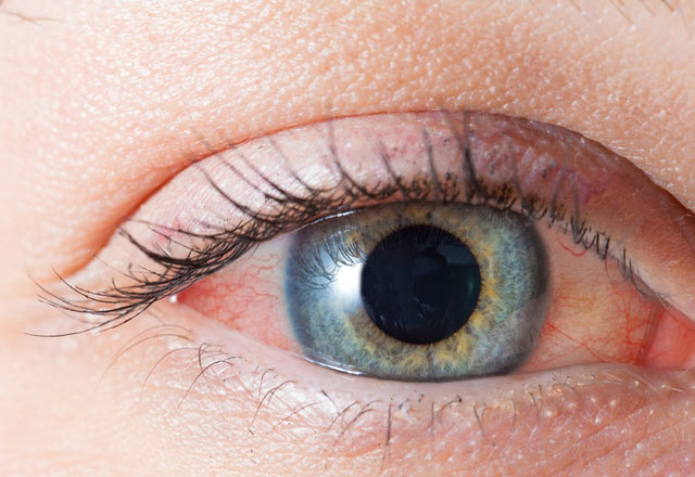 Göz yaşarması hangi hastalığın belirtisidir? - Genel Sağlık Haberleri