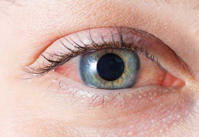 Göz alerjileri göz kaybına neden olabilir